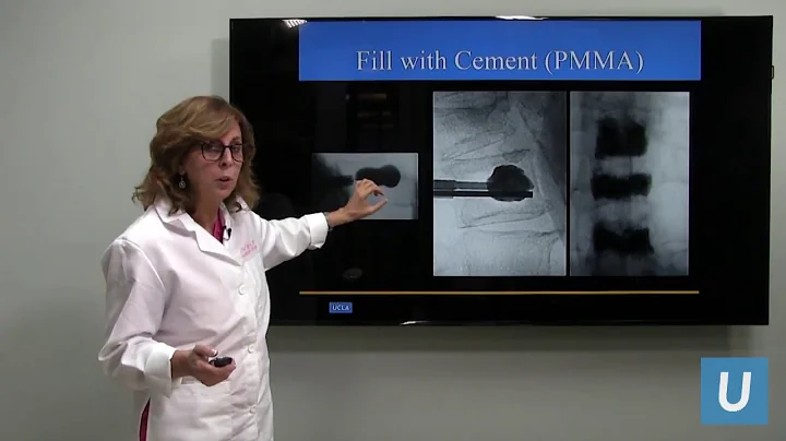 Minimally Invasive Relief for Painful Back Fractur...