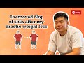 I removed 6kg of skin after my drastic weight loss