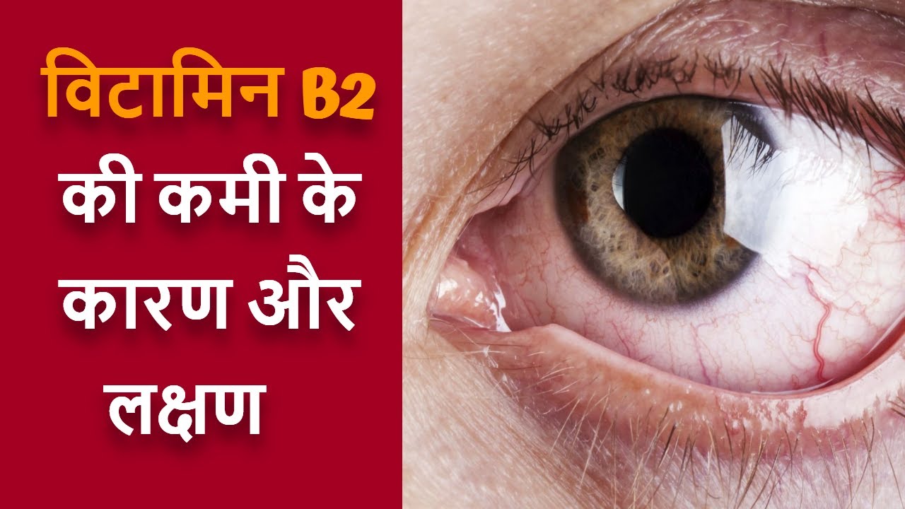 विटामिन B2 की कमी के कारण और लक्षण vitamin b2 (riboflavin) ki kami se