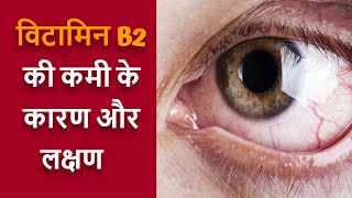 विटामिन B2 की कमी के कारण और लक्षण | vitamin b2 (riboflavin) ki kami se kya hota hai