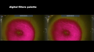 Intraoperative FFA with Alcon Ngenuity 3D system