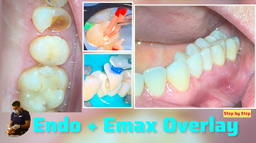 Biomimetic Dentistry: Step by Step Endodontic Treatment +  Emax Overlay | Dental Tutorial