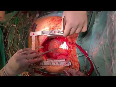 4DryField PH – Hemostasis after aortotomy