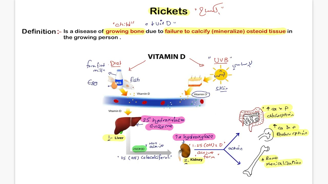 Rickets 1