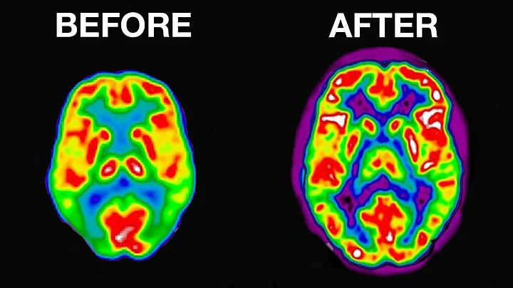 I Spent $20,000 To Rewire My Brain