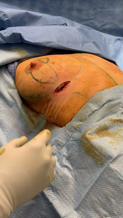 Silicone Breast Implant Rupture Discovered During Breast Augmentation Surgery