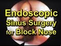 Endoscopic Sinus Surgery, Maxillary Sinus Disease