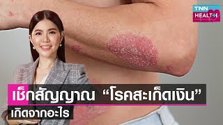 เช็กสัญญาณการเกิด “โรคสะเก็ดเงิน” เกิดจากอะไร l TNN HEALTH l 22 04 66