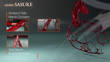 ASAHI SASUKE Double Lumen Catheter Introduction Video