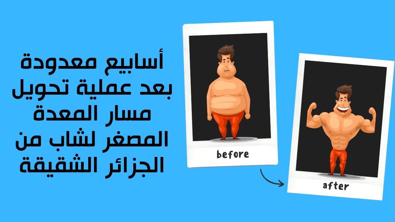 أسابيع معدودة بعد عملية تحويل مسار المعدة المصغر  لشاب من الجزائر  الشقيقة