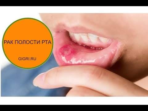 Рак полости рта: симптомы и как снизить риск развития? GIGRI.RU