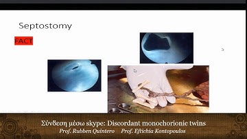 Discordant monochorionic twins & Twin -twin transfusion syndrome - E. Kontopoulos & R. Quintero