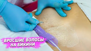 Вросшие волосы в зоне БИКИНИ - Как избавиться?