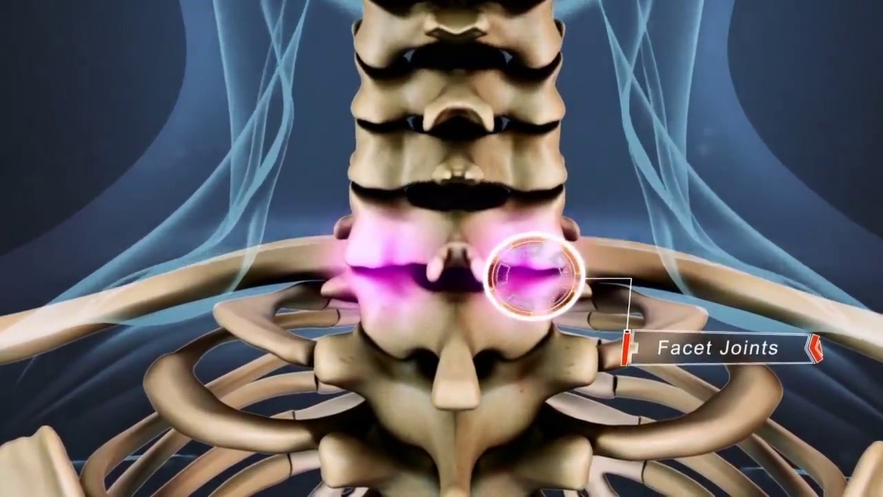 Cervical Spine Shortening - Med Treatments India - YouTube