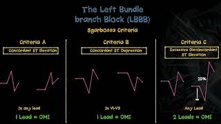 Understanding Sgarbossa Criteria - Good Reads