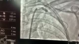 Subclavian Angioplasty