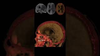 3Dct Brain Lt Mca Infarct