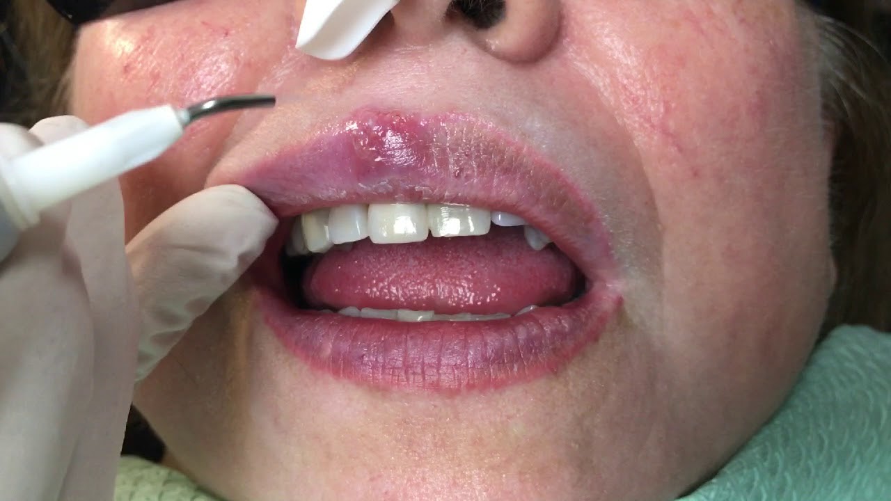 Houston Cosmetic Dentist...How Lasers can Zap cold sores! - YouTube