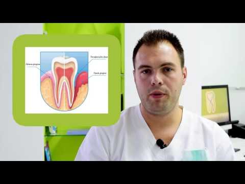 Gingivitis i parodontitis