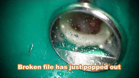 Removal of the non-visible broken file with the 90-degree preparation using Katana-H ultrasonic tip