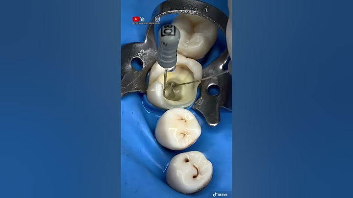 ¡Limas de ENDODONCIA para realizar un tratamiento de conducto en una muela(ADIÓS AL NERVIO)!