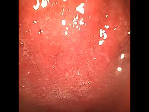 Риноскоп.👃Эндоскопия.Риноскопия при нафтизиновой зависимости.Моя история в описании.