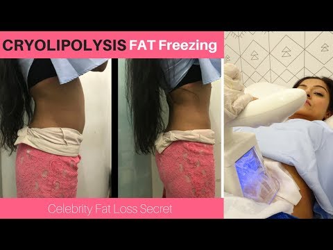 Spot Reduction of Fat ! ! Does Cryolipolysis work ? Fastest Way to Flat Stomach