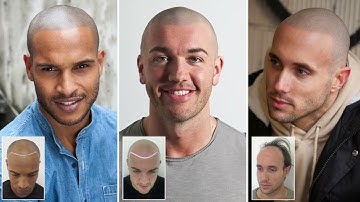 Skalp® Scalp Micropigmentation Hair Loss Tattoo
