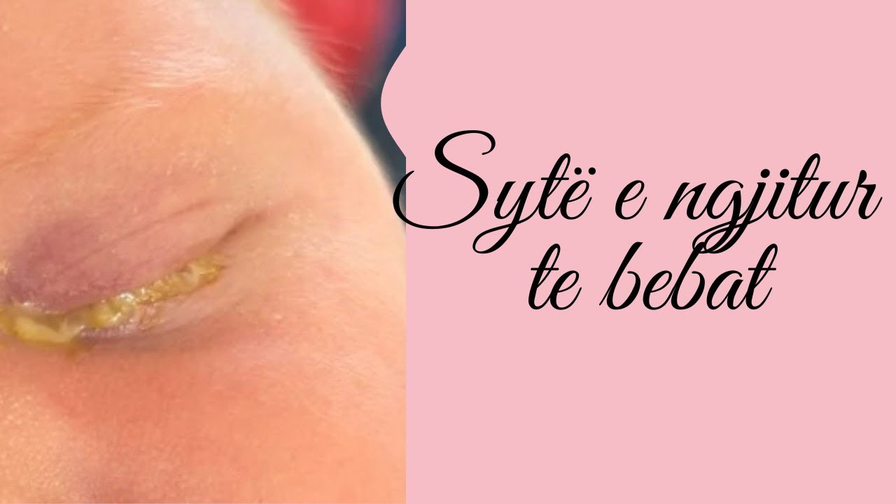KUJDES/Sytë e ngjitur i ngatërrojnë me infeksion.Provoni këtë metodë para se të përdorni antibiotik
