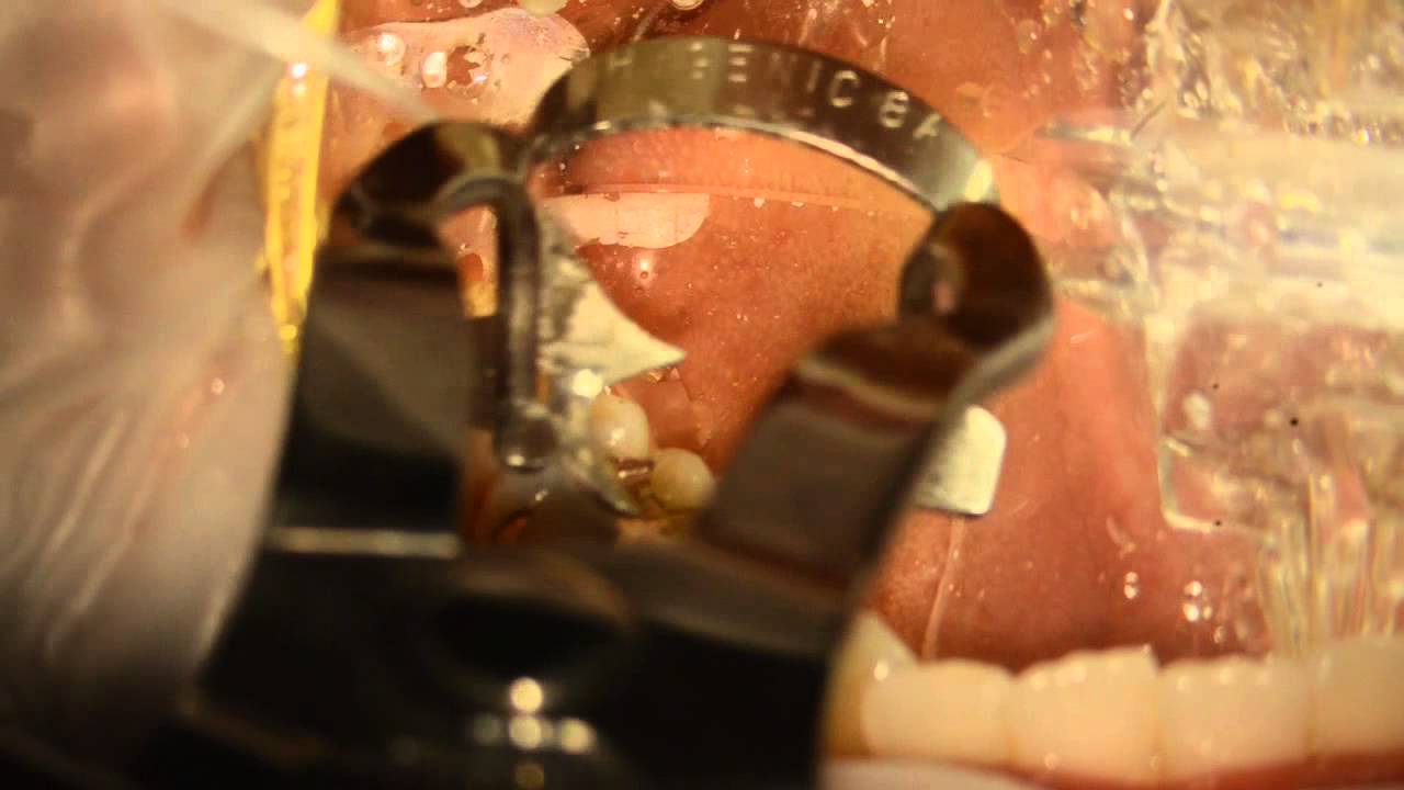 Safe Removal of Amalgam YouTube