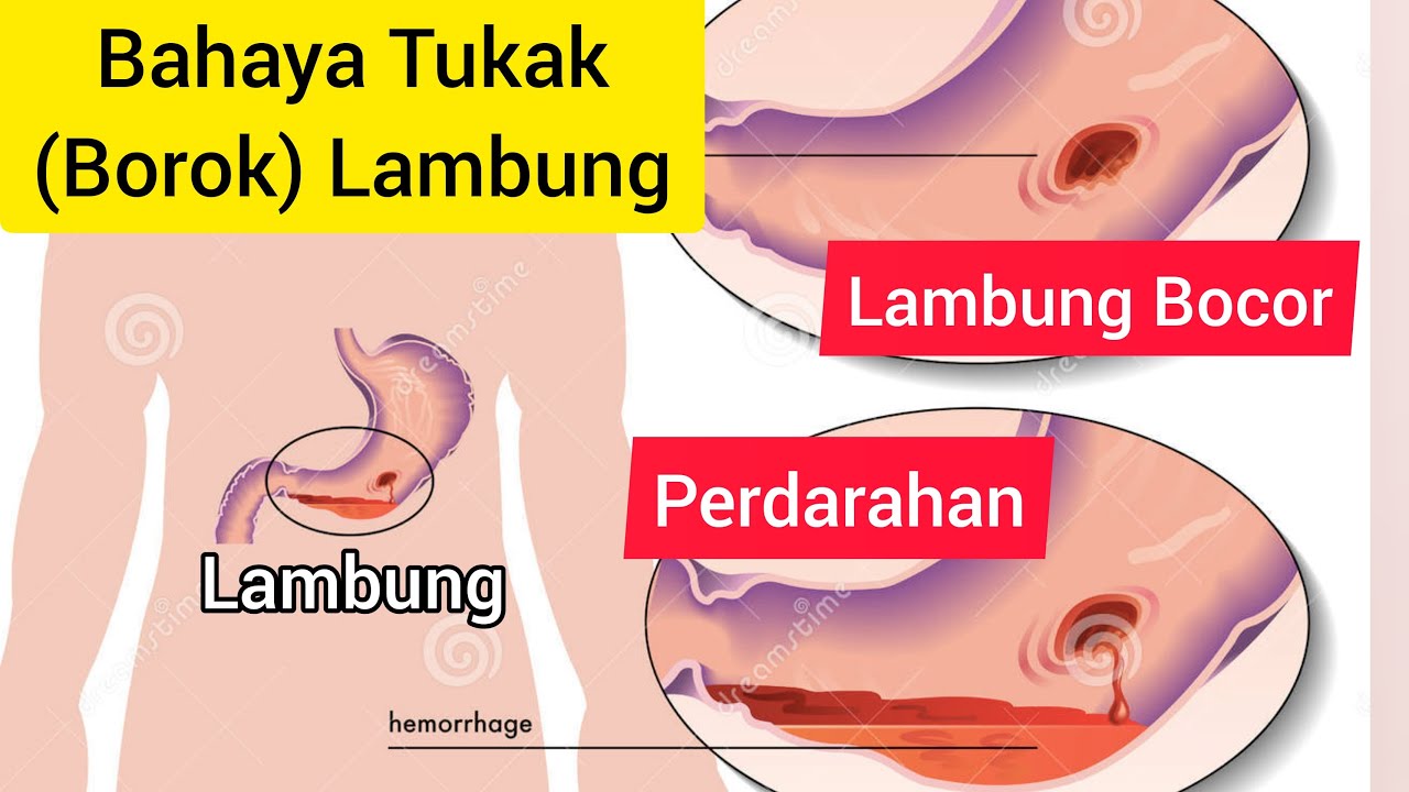 3 Cara Pertolongan Pertama Ketika Sakit Maag Kambuh