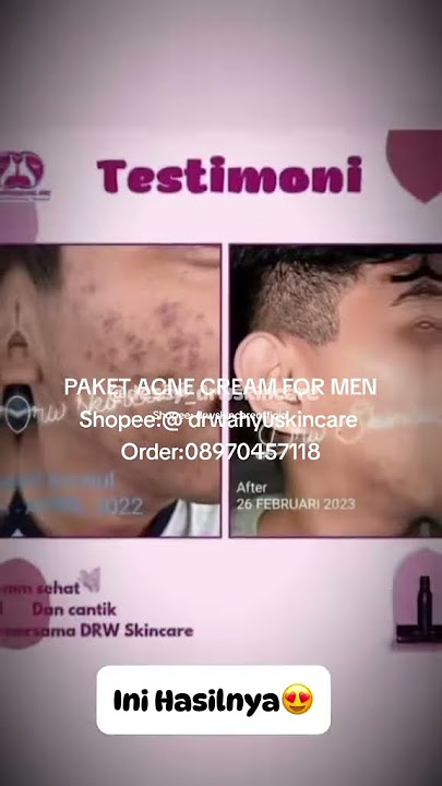 DRW SKINCARE PAKET ACNE CREAM FOR MEN #skincareformen