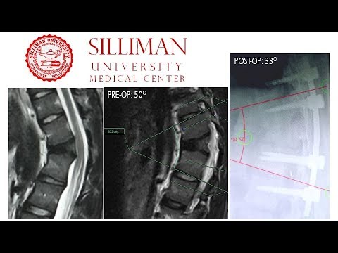 T11 T12 Laminectomy T10 L2 Instrumented Fusion For T12 Collapse Budgetmealortho Youtube