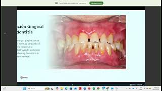 Charla sobre higiene interproximal