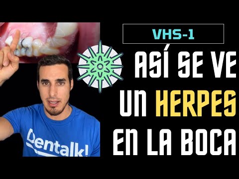 Video: ¿El herpes labial está dentro de la boca?