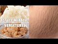 ASTUCE NATURELLE MIRACLE POUR EFFACER LES VERGETURES