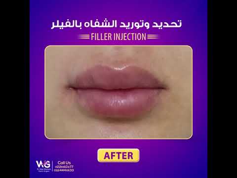 نتيجة مدهشة لتوريد الشفايف بالفيلر