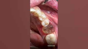 Tooth Autotransplantation / Autotrasplante Dental. #dental #dentistry #dentist #dentaltreatment