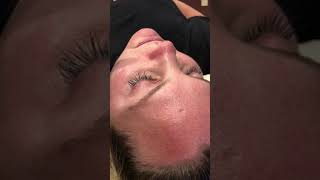 What's A HydraFacial Step 3: Extractions
