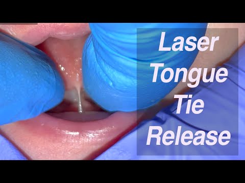 Laser Tongue Tie Release