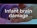 Infant Brain Damage Braindamage mp3