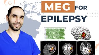 Magnetoencephalography Meg Test Reveals The Brains Hidden Epilepsy