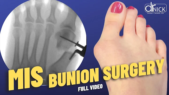 Tiny Incision, Big Fix: Bunion Surgery You Won’t Believe