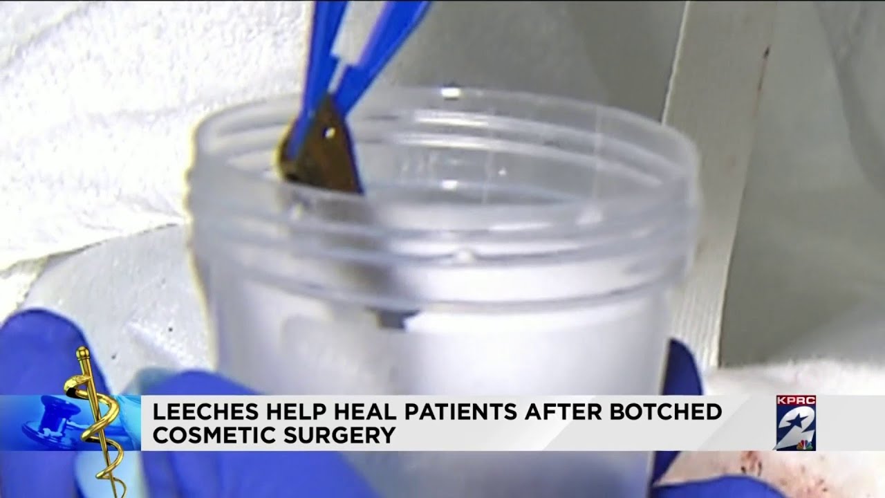 Leeches help heal patients after botched cosmetic surgery YouTube