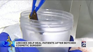 Leeches help heal patients after botched cosmetic surgery