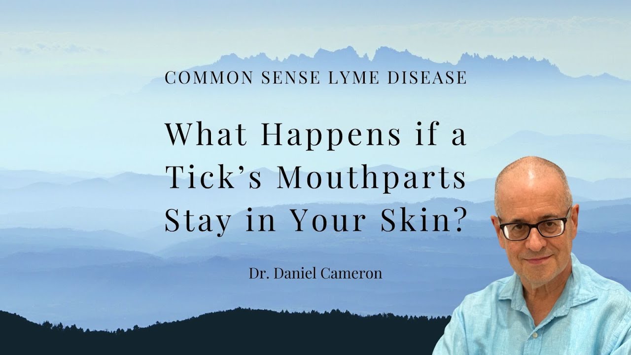 What happens if a tick't mouth part stays in your skin?