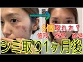 初のシミ取りレーザーしました！シミ取りしてからの1ヶ月間経過レポを載せました！