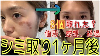 初のシミ取りレーザーしました！シミ取りしてからの1ヶ月間経過レポを載せました！