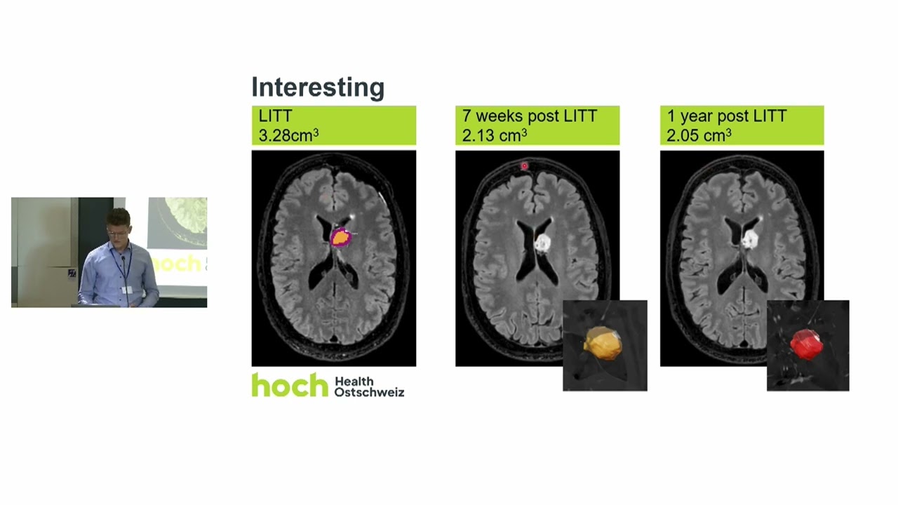 C9 Minor Results of LITT in Ependymomas: Report of 2 Cases.