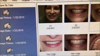 Replacing a Missing Tooth | Dr. Steve Marsh | Cleveland Cosmetic Dentist